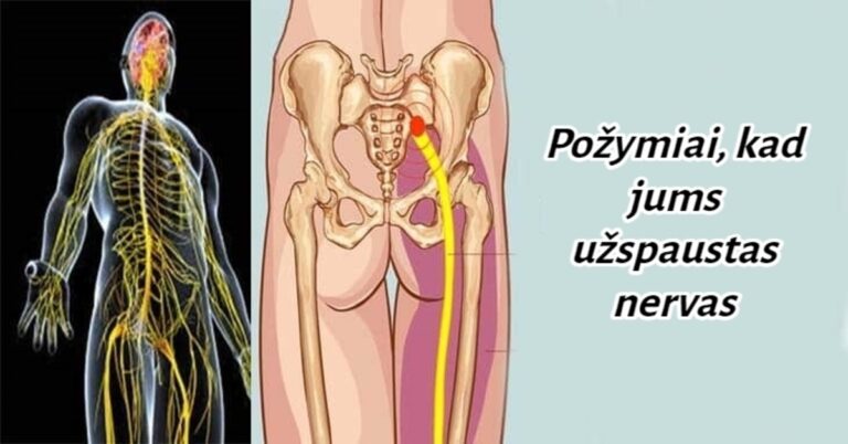 Niekada neignoruokite šių užspausto nervo simptomų!