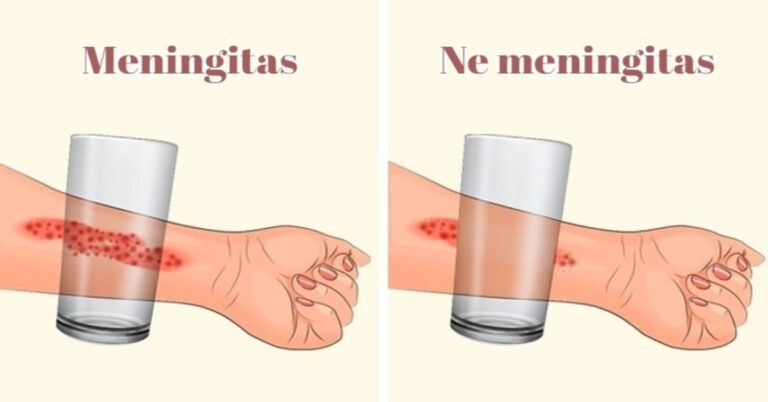 8 meningito simptomai, kuriuos turėtų žinoti kiekvienas tėvas