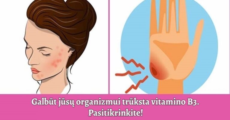 Šie ženklai rodo, kad jūsų organizmui trūksta vitamino B3